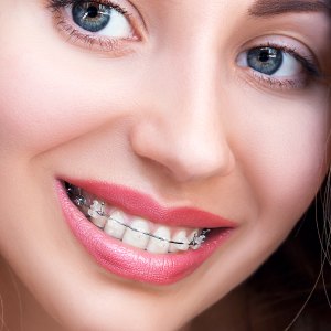 Braces at Winslow Dental Near Me in Winslow, AZ