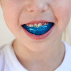 Braces at Winslow Dental Located in Winslow, AZ Braces at Winslow Dental Located in Winslow, AZ