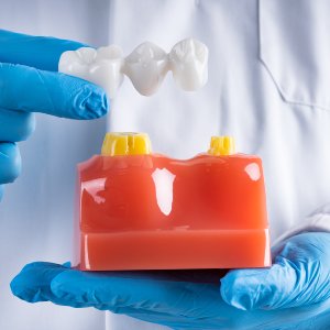 Dental Bridge at Winslow Dental Near Me in Winslow, AZ